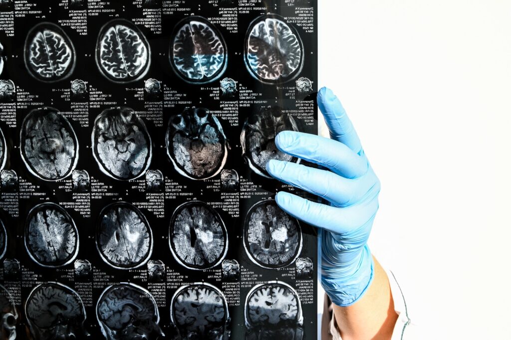 Doctor in protecting gloves holding brain MRI in medical office. MRI scan of human head in clinic.